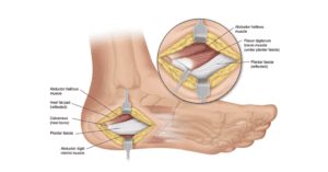 FASCIOCTOMY