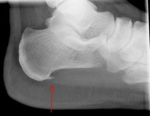 X-ray of Plantar Fasciitis