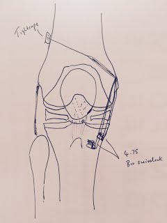 Knee arthroscopy