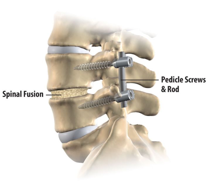 Spinal Fusion Surgery