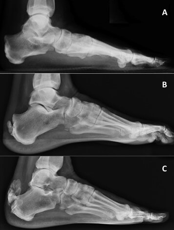  X ray in achillis Tendinitis