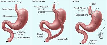 Bariatric surgery