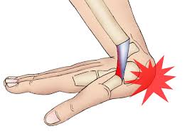 Overstretched Wrist sprain