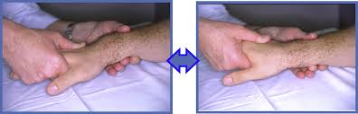 MID CARPAL INSTABILITY