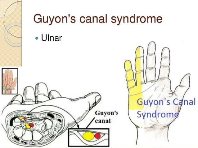 Guyon Canal Syndrome Ulnar Tunnel Syndrome Samarpan