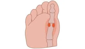 Sesamoiditis Cause Symptoms Treatment