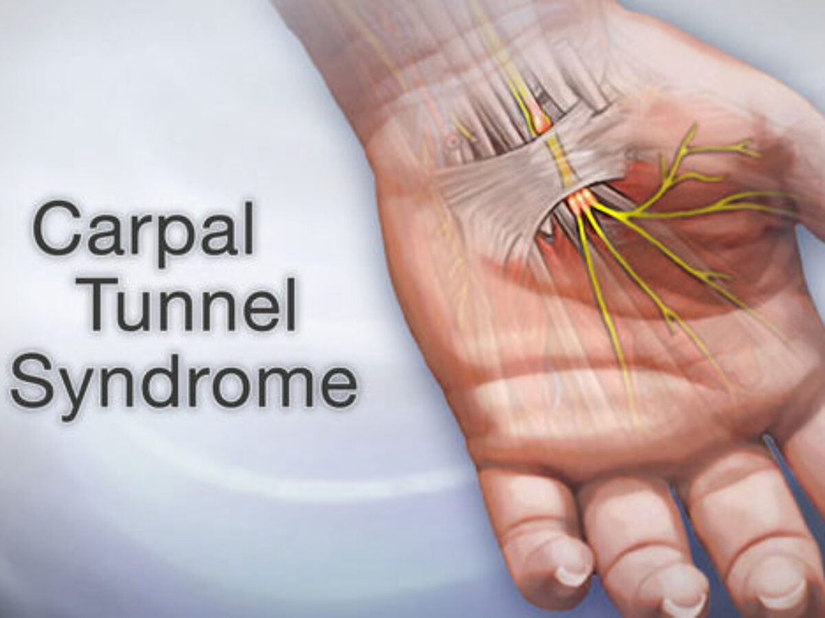 carpal tunnel treatment