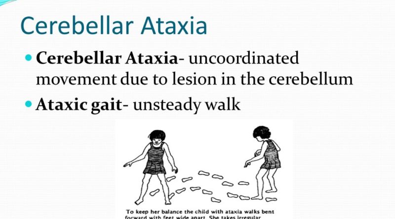 Cerebellar Signs And Symptoms