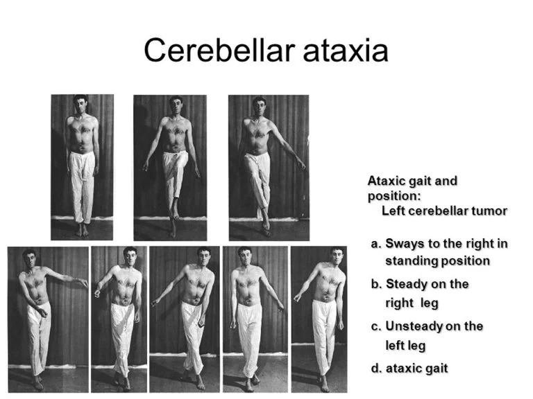 Cerebellar ataxia Ataxic gait and position