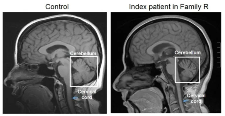 MRI of Brain