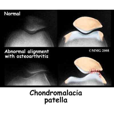 Chondromalacia patellae Diagnosis