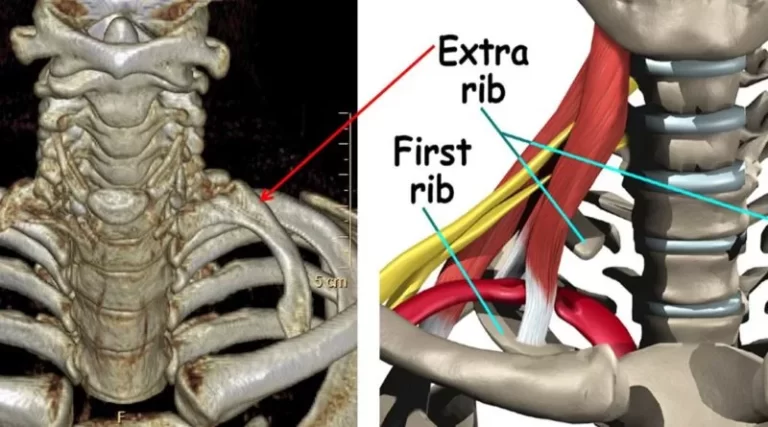 cervical rib as an extra rib