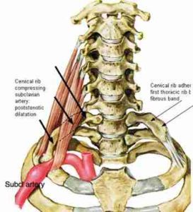 Subclavian Artery - Anatomy, Course, Branches