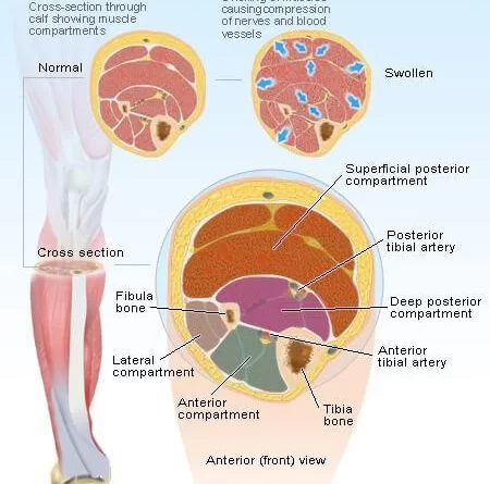 Compartment syndrome