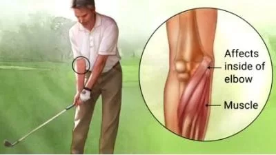 Golfer’s elbow