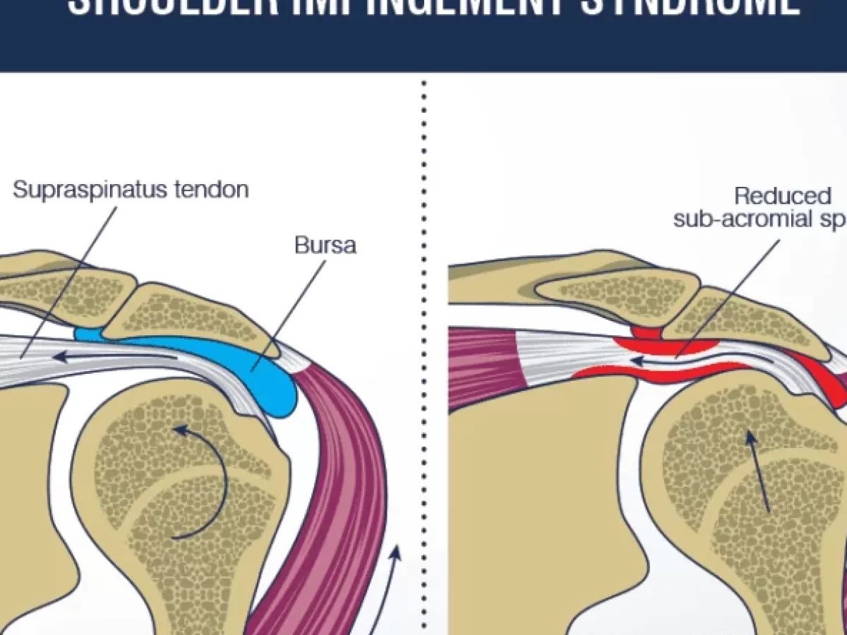 Compartment Syndrome: Physiotherapy Treatment