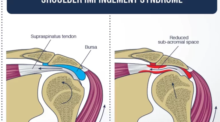 Painful arc syndrome