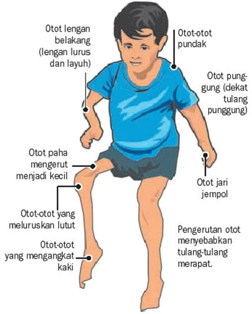 Residual Poliomyelitis