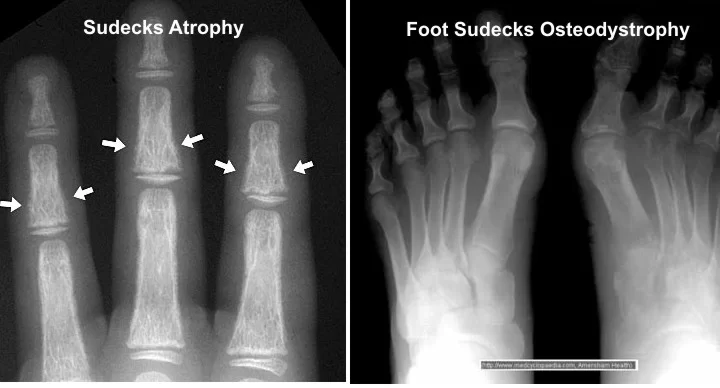 Sudeck's atrophy