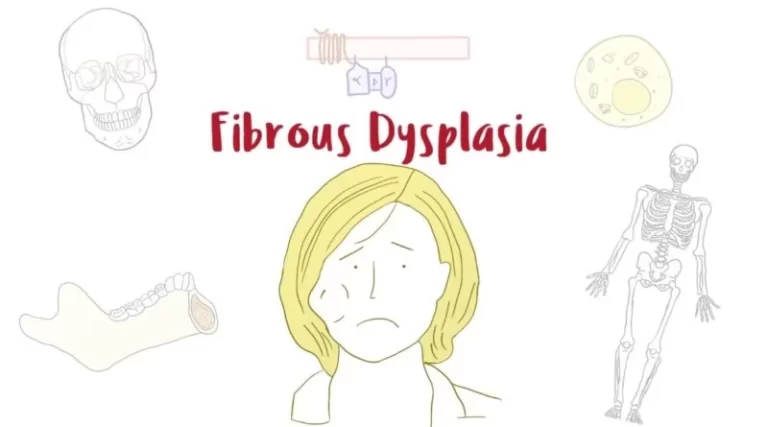 Fibrous Dysplacia