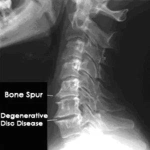 Cervical spondylosis X-Ray Bone spur
