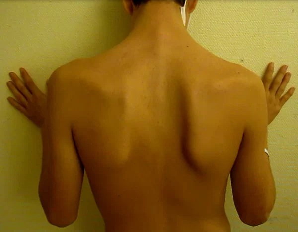 Type 1 winging of the scapula