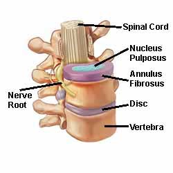 How to Heal a Lumbar Herniated Disc Quickly?