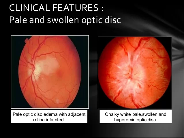 anterior-ischemic-optic-neuropathy