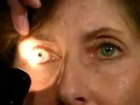 pupillary light reflex