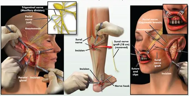 surgery for Facial palsy