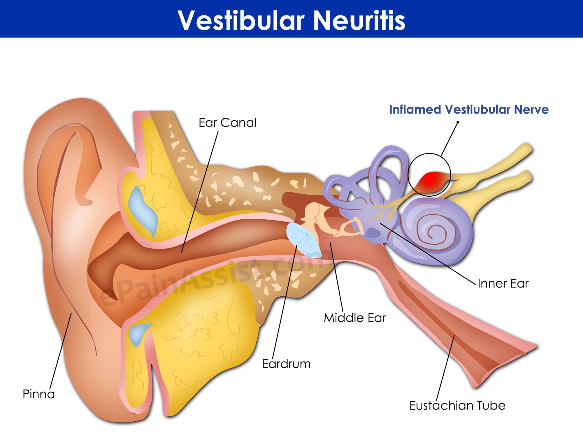 Нейропатия слухового нерва