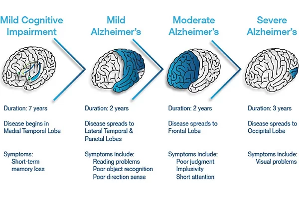Alzheimers_Disease_Stages