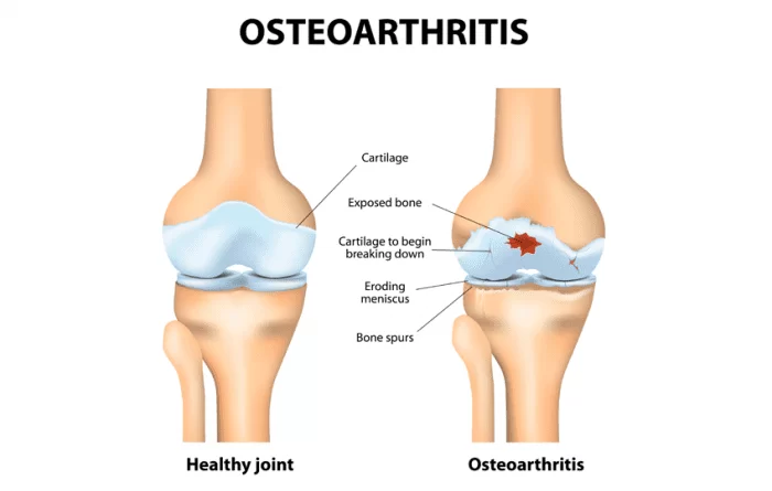 Osteoarthritis