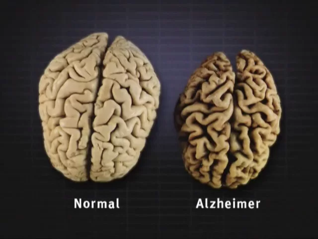 alzheimer-brain-changes