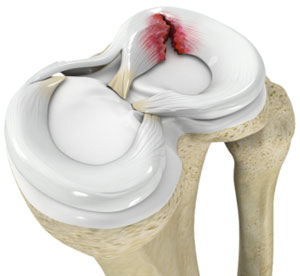 Meniscus tear in Knee : Physiotherapy treatment