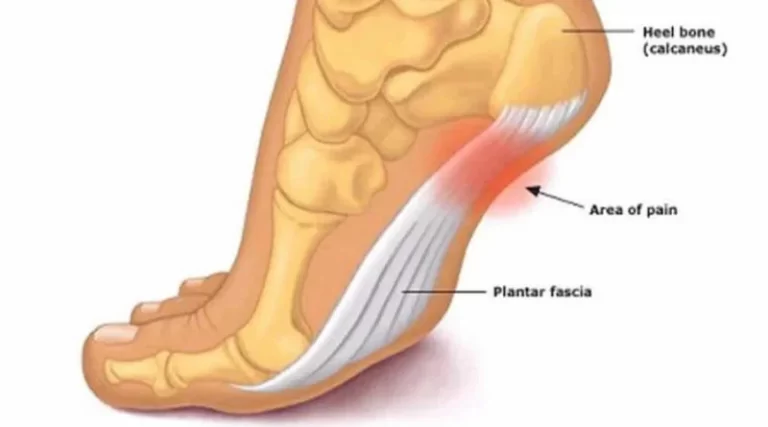 plantar fasciitis