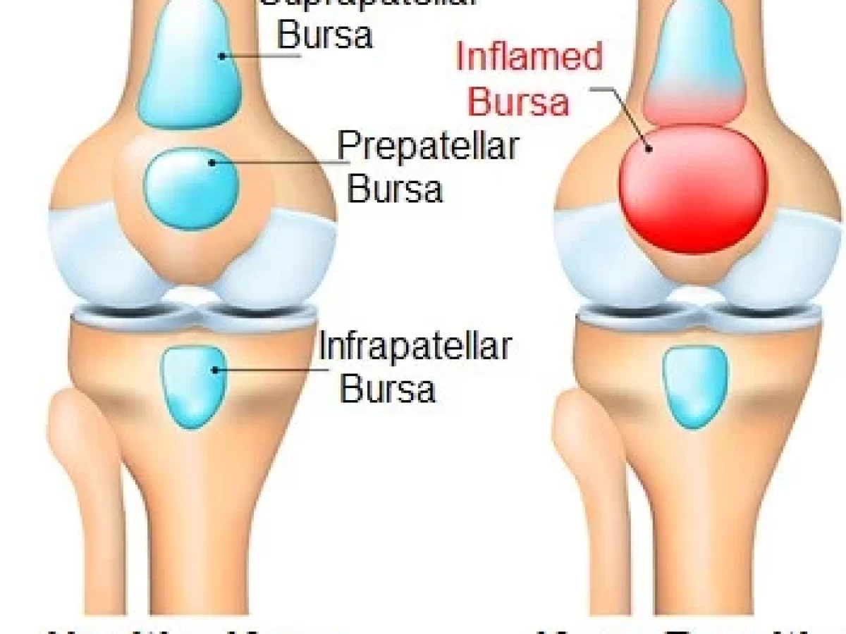 13 Best Exercise For Deep Infrapatellar Bursitis - Samarpan