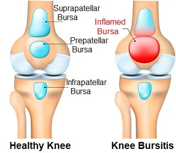 Knee Bursitis