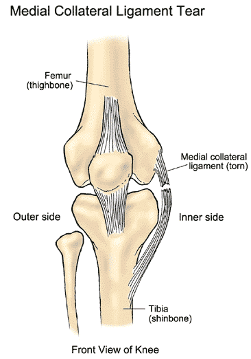 medial collateral ligament Tear