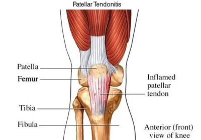 Patellar Tendinitis