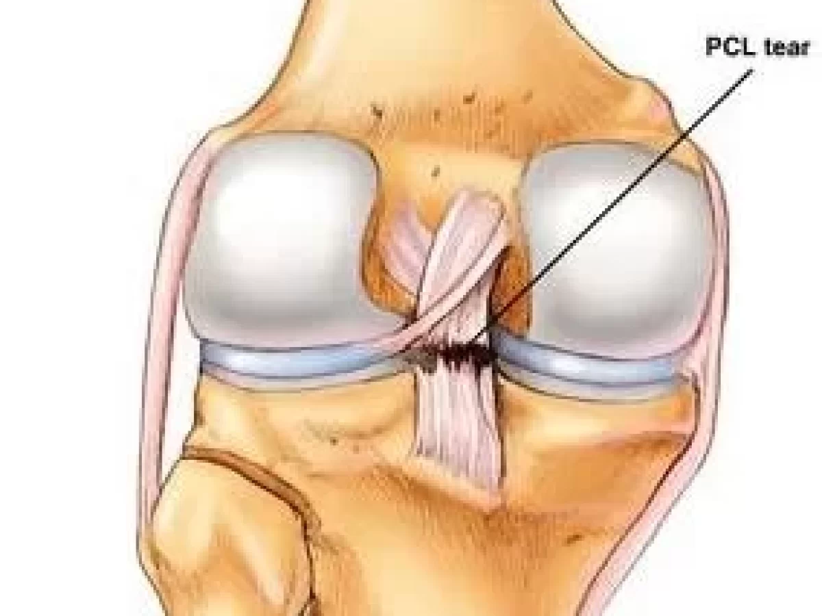 Posterior cruciate ligament injury (PCL), Physiotherapy treatment