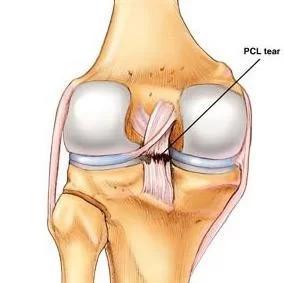 Posterior Cruciate Ligament Injury