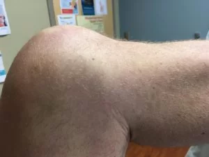 Posterior sag sign