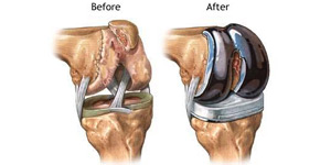 Total knee joint replacement