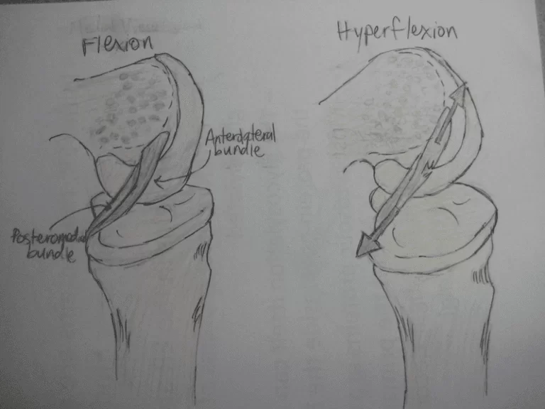 posterior cruciate ligament mechanism of injury