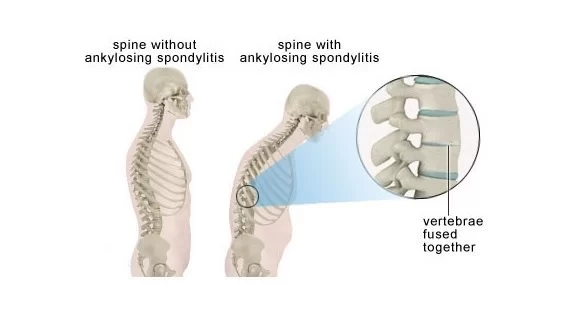 Ankylosing spondylitis Sign and Symptom’s