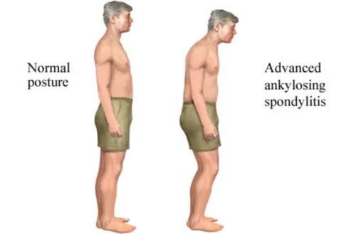 Ankylosing spondylitis