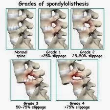 Grade of Spondylolisthesis