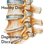 Lumbar Degenerative Disc Disease