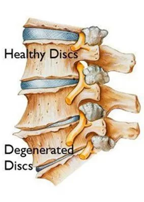 Lumbar Degenerative Disc Disease